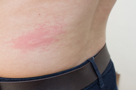 Herpes en la espalda imagenes Herpes en la espalda imagenes